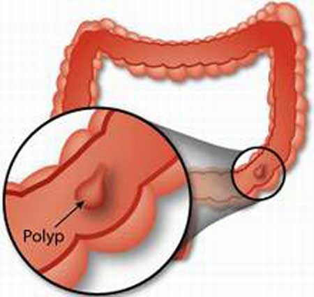 Nguyên nhân, cách điều trị bệnh polyp hậu môn