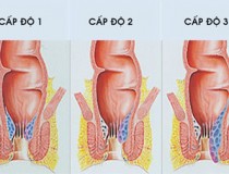 Các cấp độ của bệnh trĩ