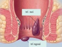 Tổng quan về trĩ hỗn hợp: Nguyên nhân và cách phòng tránh