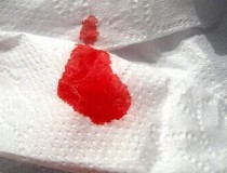 Tình trạng chảy máu sau mổ trĩ 
