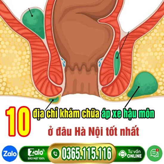 10 địa chỉ khám chữa áp xe hậu môn ở đâu Hà Nội tốt nhất