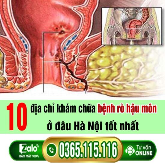 10 địa chỉ khám chữa bệnh rò hậu môn ở đâu Hà Nội tốt nhất