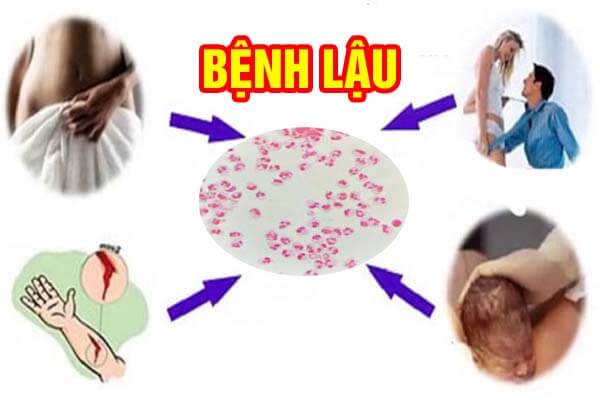 Bệnh lậu có chữa được không, bị bệnh lậu có tự khỏi không