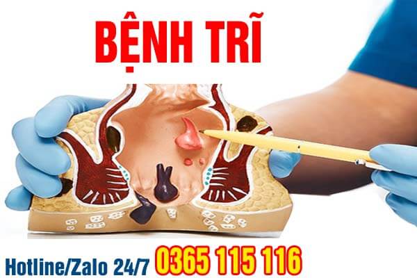 Bệnh trĩ là gì, cách nhận biết bệnh trĩ qua dấu hiệu hình ảnh