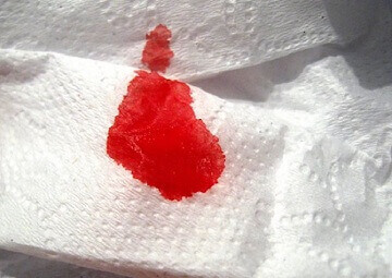 Hiện tượng chảy máu sau khi cắt trĩ