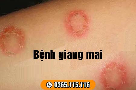 8 bệnh xã hội thường gặp nguy hiểm và dấu hiệu nhận biết