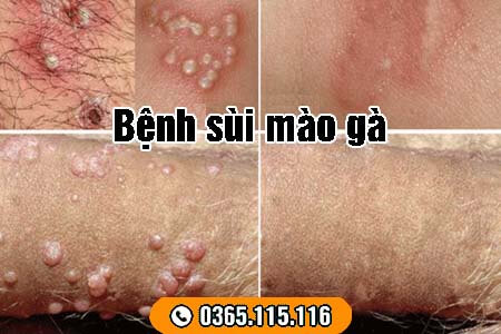 8 bệnh xã hội thường gặp nguy hiểm và dấu hiệu nhận biết