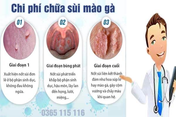 Chi phí chữa sùi mào gà bao nhiêu tiền? Bảng giá năm 2024