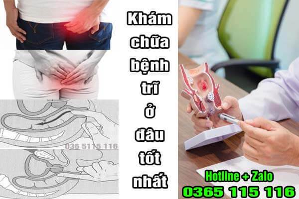 Top 15 địa chỉ chữa bệnh trĩ, cắt trĩ ở đâu tốt nhất Hà Nội