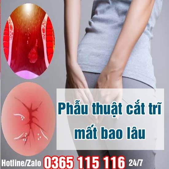 Phẫu thuật cắt trĩ mất bao lâu, cần nghỉ ngơi bao lâu?