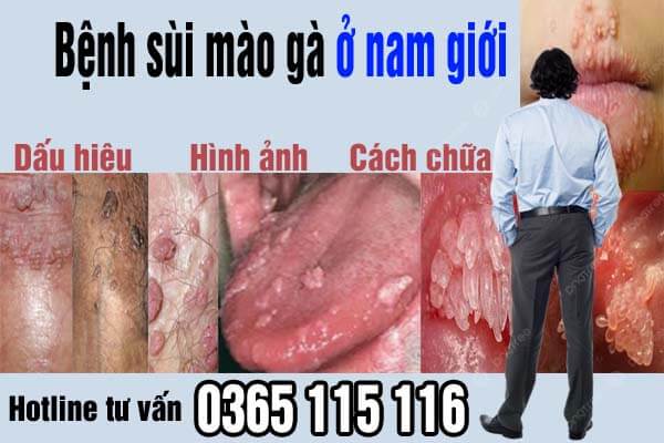 Bệnh sùi mào gà ở nam giới: Dấu hiệu, hình ảnh, cách chữa